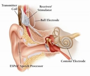 cochlear implant